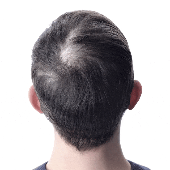 MICRONEEDLE  HAIR