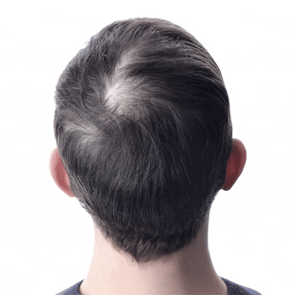 MICRONEEDLE  HAIR