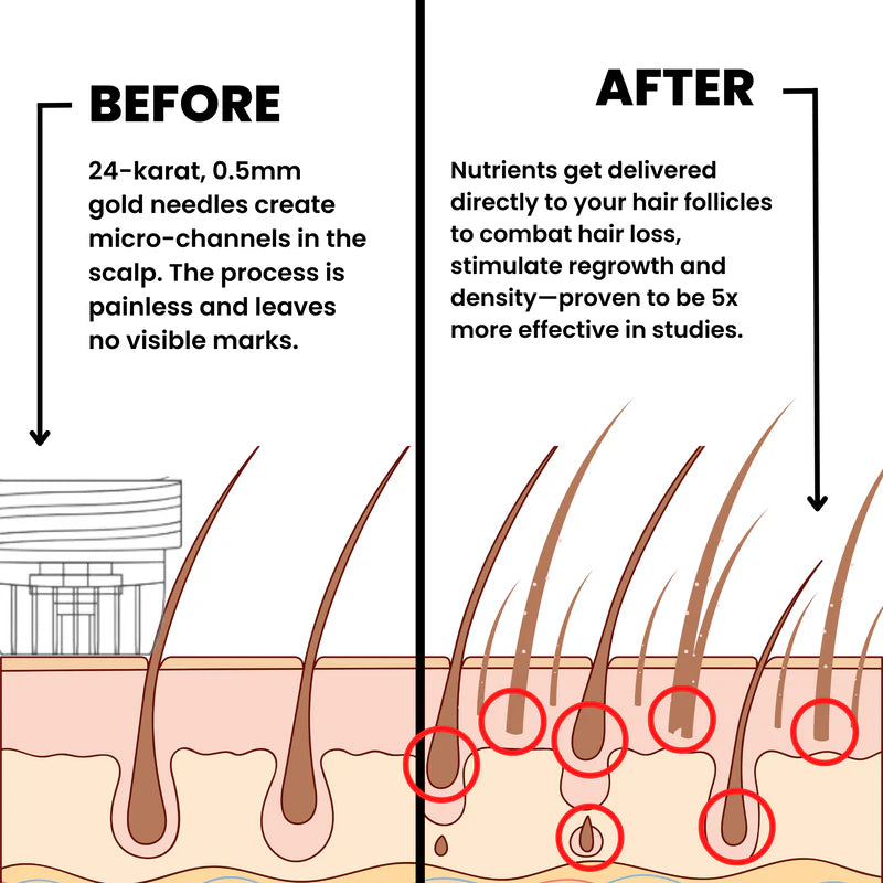 MICRONEEDLE  HAIR