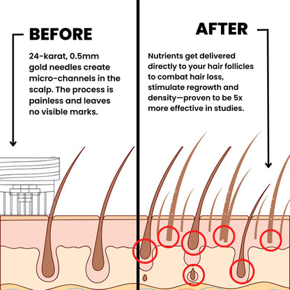 MICRONEEDLE  HAIR